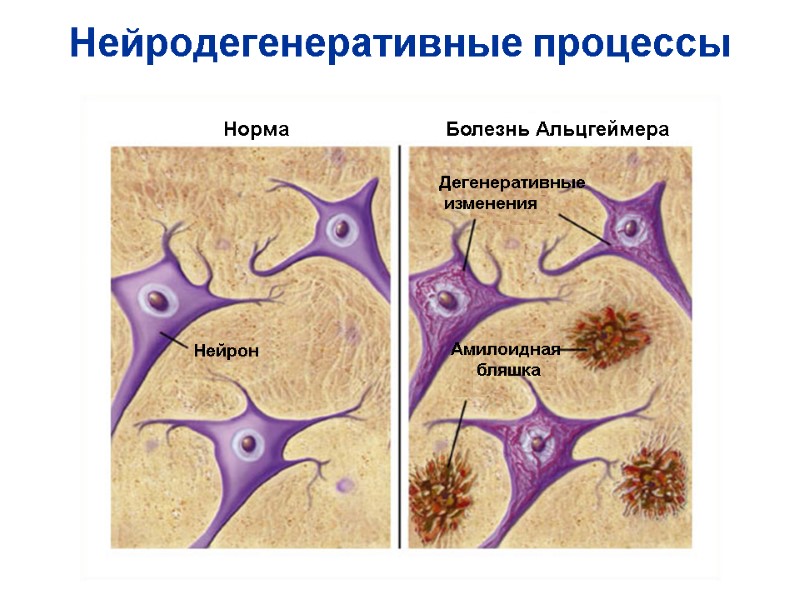 Нейродегенеративные процессы Норма Болезнь Альцгеймера Нейрон Амилоидная  бляшка Дегенеративные  изменения